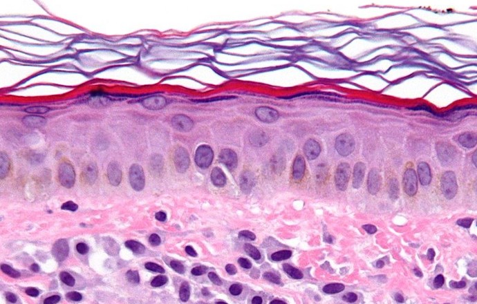 Wielu specjalistów, jedna choroba – czym jest mastocytoza?