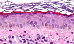 Wielu specjalistów, jedna choroba – czym jest mastocytoza?