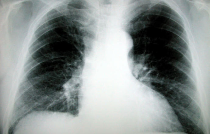 Inhibitory PARP w terapii nowotworu płuc
