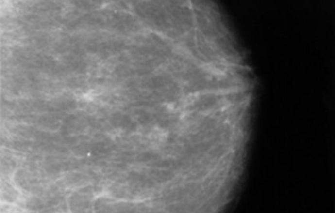 Już wiemy, jak powstaje lekooporny rak piersi!