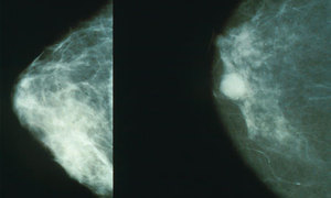 Wczesne stadia raka piersi mogą być wkrótce diagnozowane poprzez badanie krwi