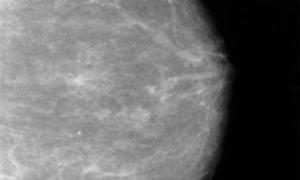 Nanocząstki jako ratunek przed dziedzicznym rakiem piersi