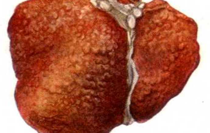 Rak wątrobowo-komórkowy- jedno z długofalowych następstw zakażenia wirusem zapalenia wątrob