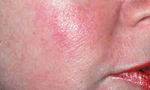 Bez skazy na twarzy - podstawy pielęgnacji cery naczynkowej 