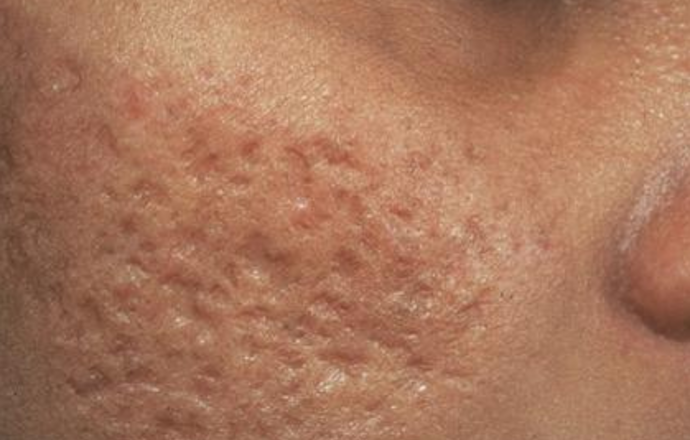 Mikronakłuwanie skóry – sposób na blizny 