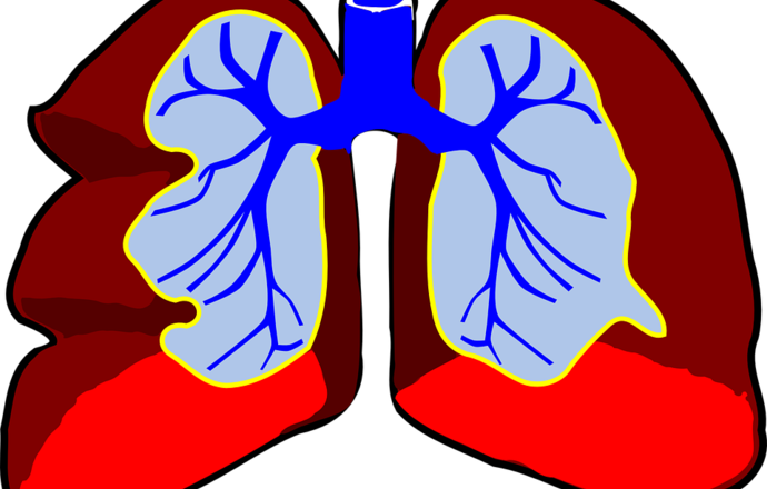 Leczenie raka płuca niwolumabem - wyniki badań klinicznych