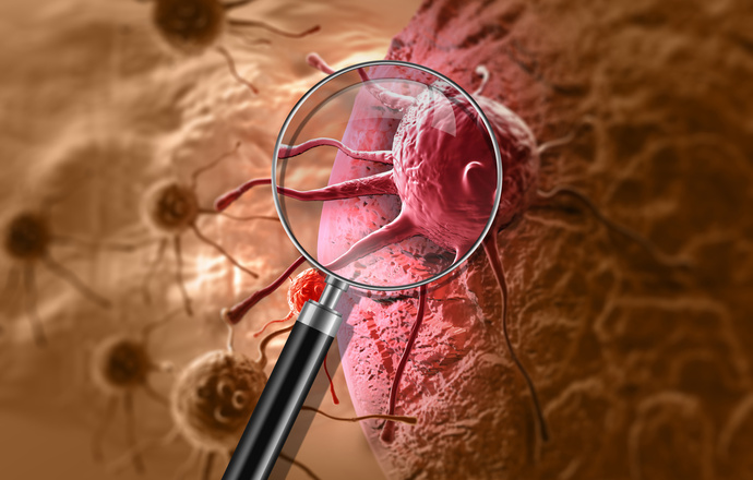 Metabolizm komórki nowotworowej a oporność na stosowaną terapię