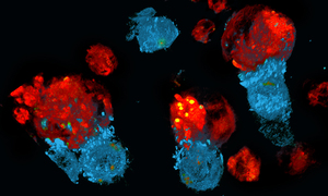Rozpoznanie i leczenie chłoniaka rozlanego z dużych komórek B