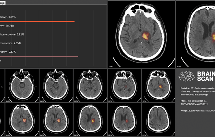 Polski start-up zwiększy skuteczność tomografii komputerowej mózgu