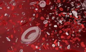 Hemofilia – częsta skaza krwotoczna wśród chorób rzadkich