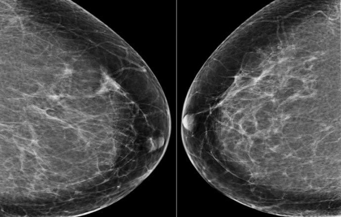 Narzędzie DeepMind, mammografia 3D (tomosynteza) czy elastografia – oto współczesna diagnos
