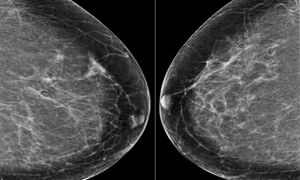 Narzędzie DeepMind, mammografia 3D (tomosynteza) czy elastografia – oto współczesna diagnos
