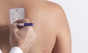 TRUE test w badaniach alergicznych skóry – na czym polega?