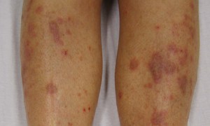 Rzadkie dermatozy o podłożu autoimmunologicznym – pęcherzyca skóry i liszaj płaski