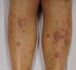 Rzadkie dermatozy o podłożu autoimmunologicznym – pęcherzyca skóry i liszaj płaski