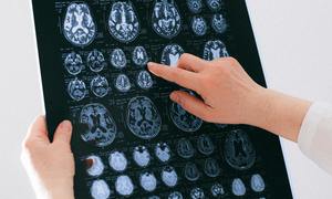 Innowacyjne podejście do diagnostyki oraz terapie chorób mózgu ratują życie i poprawiają je