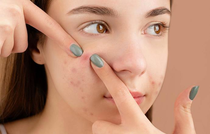 Czy biomikroigły krzemionkowe mogą zredukować trądzik?