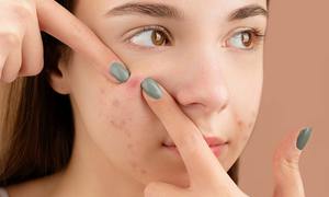 Czy biomikroigły krzemionkowe mogą zredukować trądzik?