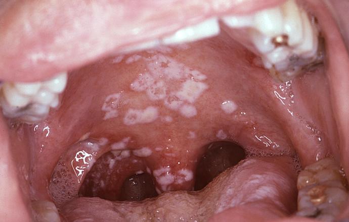 Poważne grzybice w Polsce – nowe dane pokazują skalę porównywalną z chorobami cywilizacyjny