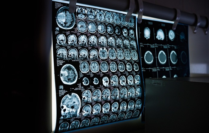 Wstrzykiwane implanty otwierają nowe możliwości leczenia neurologicznego