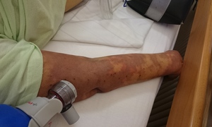 Wczesna diagnostyka sepsy ratuje życie