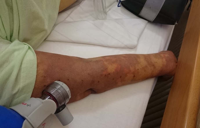 Wczesna diagnostyka sepsy ratuje życie