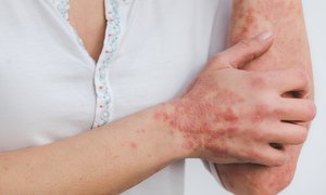 Suplementacja w dermatozach skórnych – AZS, ŁZS i łuszczycy
