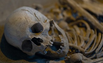 Ślady rekonstrukcji żuchwy u kobiety sprzed 2,5 tys. lat